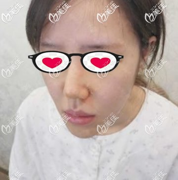 蘭州夢(mèng)想整形趙梅霞面部提升第2天圖片