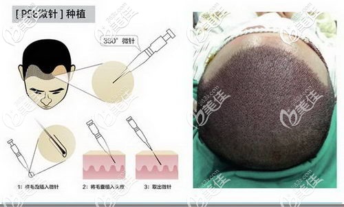 微針植發(fā)原理及效果展示 微針植發(fā)原理及效果展示