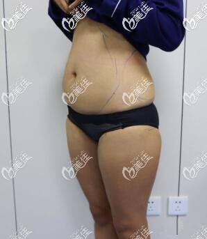 我術(shù)前的樣子 我術(shù)前的樣子