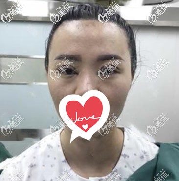 蘭州時光相伴整形全切7毫米雙眼皮術(shù)后即刻 蘭州時光相伴整形全切7毫米雙眼皮術(shù)后即刻