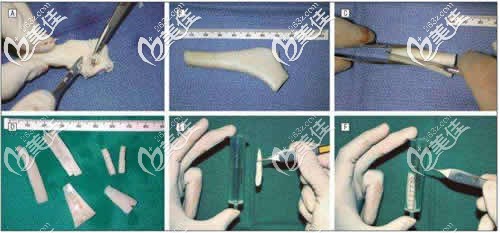 異體骨隆鼻雕刻過程示意圖 異體骨隆鼻雕刻過程示意圖
