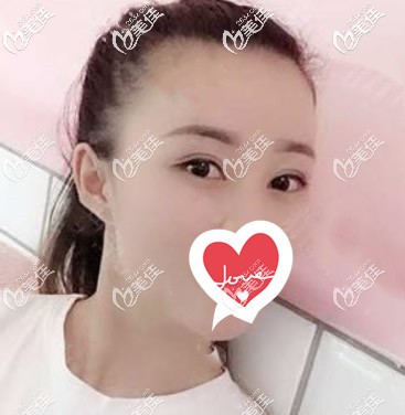 全切雙眼皮7mm恢復(fù)后會成內(nèi)雙嗎?瞅瞅蘭州時光相伴整形趙梅霞給我做眼睛40天的效果!