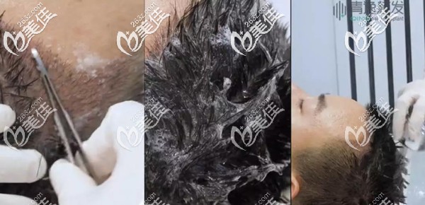 植發(fā)4天后清洗血痂步驟圖 植發(fā)4天后清洗血痂步驟圖