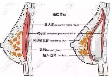 假體隆胸手術(shù)剝離位置