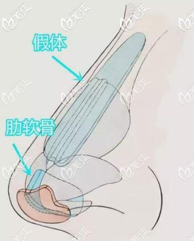 半肋骨隆鼻常見的手術方法 半肋骨隆鼻常見的手術方法
