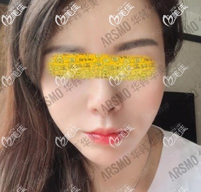 在長(zhǎng)沙做M唇整形術(shù)后15天效果照
