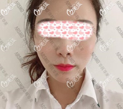 在長沙華韓華美做的M唇不僅效果好，而且價格也很公道，給大家看下恢復(fù)后的圖片吧！