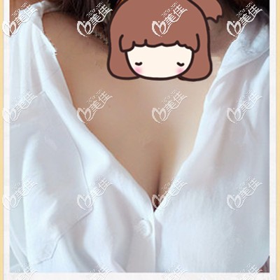 術(shù)后一個(gè)月恢復(fù)的不錯(cuò)