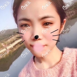 說做了8次紅藍(lán)光治療沒有效果的寶寶來看我做2次激光祛痘恢復(fù)圖怎么樣