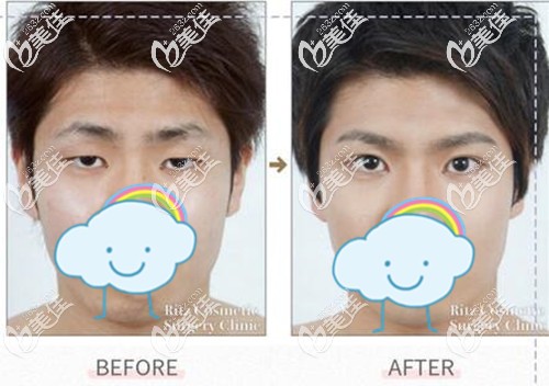 從三組日本Ritz美容外科醫(yī)院看永井宏治醫(yī)生做日式埋線雙眼皮術后效果到底自不自然