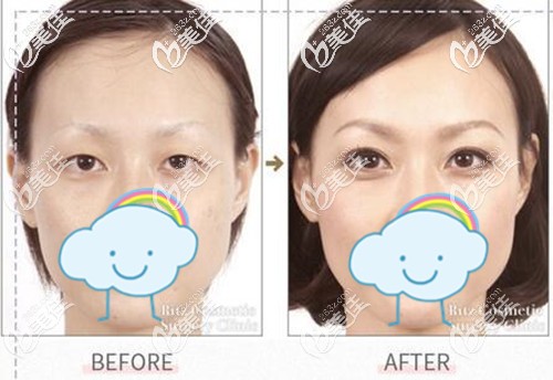 做埋線雙眼皮術(shù)前術(shù)后改善效果 做埋線雙眼皮術(shù)前術(shù)后改善效果