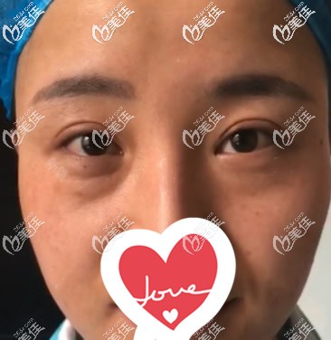 蘭州韓美整形醫(yī)院陽贊軍院長去眼袋前 蘭州韓美整形醫(yī)院陽贊軍院長去眼袋前