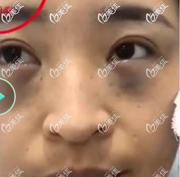 蘭州韓美陽贊軍內(nèi)切去眼袋+淚溝回填第1天 蘭州韓美陽贊軍內(nèi)切去眼袋+淚溝回填第1天
