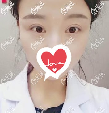 內(nèi)切眼袋手術(shù)1-10天圖片 內(nèi)切眼袋手術(shù)1-10天圖片