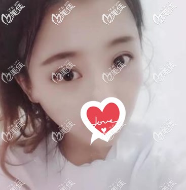 在蘭州韓美做了內(nèi)切+眶隔釋放去眼袋手術(shù),二個(gè)多月后一點(diǎn)也不腫還把淚溝填平了!