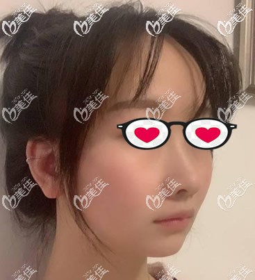 蘭州韓美整形醫(yī)院韓士生科硅膠假體隆下巴前 蘭州韓美整形醫(yī)院韓士生科硅膠假體隆下巴前