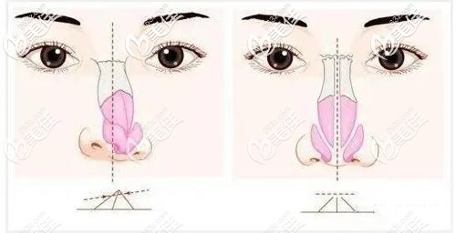 歪鼻矯正手術(shù)原理