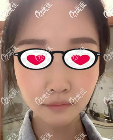 硅膠假體墊下巴第十天拆線(xiàn)后圖片 硅膠假體墊下巴第十天拆線(xiàn)后圖片