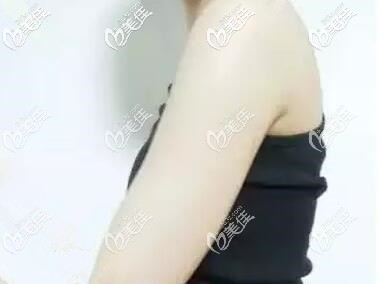 泰國吸脂效果好嗎？看了我在泰國曼古雨季做的手臂吸脂術(shù)后30天恢復(fù)圖就知道了！