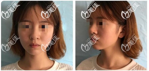 做自體軟骨隆鼻手術(shù)前的樣子 做自體軟骨隆鼻手術(shù)前的樣子