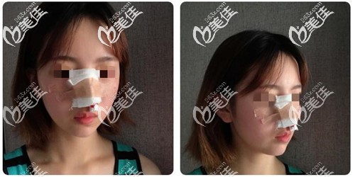手術(shù)后第二天鼻子綁著紗布 手術(shù)后第二天鼻子綁著紗布