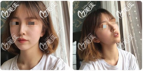 自體肋軟骨隆鼻半個(gè)月恢復(fù)效果 自體肋軟骨隆鼻半個(gè)月恢復(fù)效果