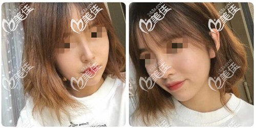 自體肋軟骨隆鼻3個(gè)月恢復(fù)效果 自體肋軟骨隆鼻3個(gè)月恢復(fù)效果