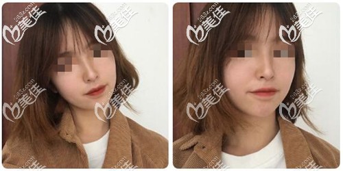 曝光肋軟骨鼻太夸張了想死的謠言，我恢復半年效果很自然而且也沒鈣化