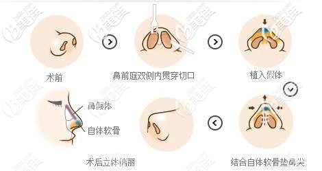 詹院長做鼻綜合手術(shù)步驟示意圖 詹院長做鼻綜合手術(shù)步驟示意圖