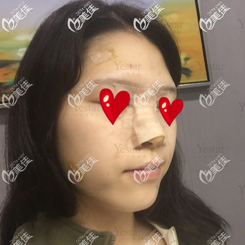 濟(jì)南藝星面部脂肪填充后