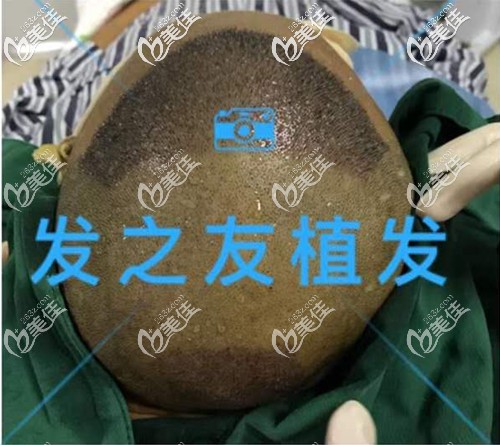 ?植發(fā)頭頂加密和發(fā)際線進(jìn)行!分享南寧發(fā)之友微針植發(fā)3500單位效果圖
