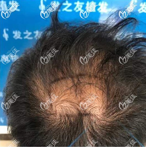 術(shù)前頭發(fā)頭發(fā)稀疏