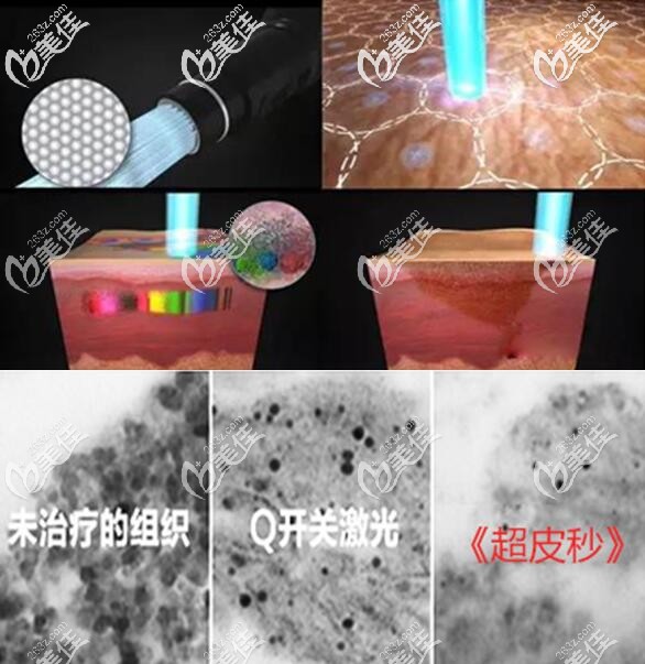 超皮秒祛斑原理