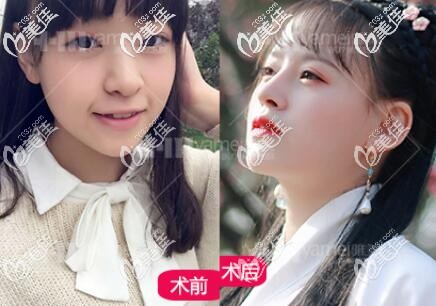 在長(zhǎng)沙雅美做鼻綜合術(shù)前術(shù)后對(duì)比照 在長(zhǎng)沙雅美做鼻綜合術(shù)前術(shù)后對(duì)比照