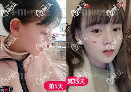 鼻綜合術(shù)后5-15天的恢復(fù)效果圖 鼻綜合術(shù)后5-15天的恢復(fù)效果圖
