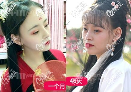 在長(zhǎng)沙做鼻綜合術(shù)后30-46天的恢復(fù)照片 在長(zhǎng)沙做鼻綜合術(shù)后30-46天的恢復(fù)照片