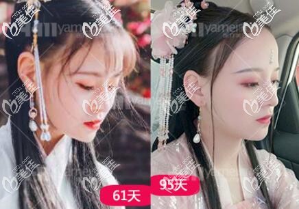 在雅美做鼻綜合術(shù)后61-95天恢復(fù)效果圖 在雅美做鼻綜合術(shù)后61-95天恢復(fù)效果圖