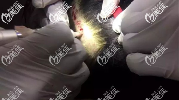 植發(fā)過程中會有少量出血