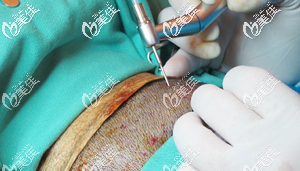 精密的植發(fā)器械能夠減少疤痕的出現(xiàn)