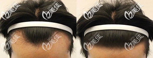 <!--<i data=20240703-sp></i>-->姚寶林發(fā)際線種植效果