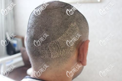 術(shù)后疤痕明顯植發(fā)失敗