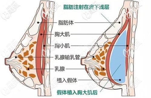 復(fù)合式隆胸的手術(shù)原理