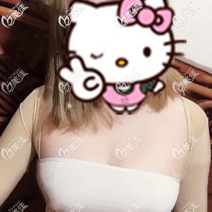 復(fù)合式隆胸術(shù)后即刻胸部變大