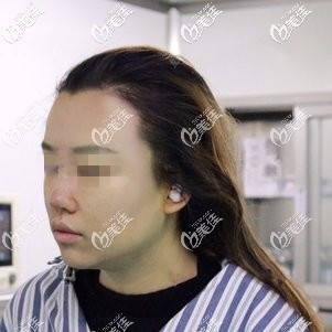 術(shù)后鼻子腫脹感較強(qiáng)烈 術(shù)后鼻子腫脹感較強(qiáng)烈