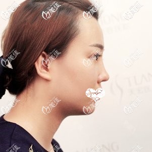 鼻綜合術(shù)后一周鼻子消腫 鼻綜合術(shù)后一周鼻子消腫