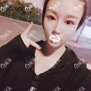 隆鼻術(shù)后1個(gè)月鼻子完全消腫 隆鼻術(shù)后1個(gè)月鼻子完全消腫