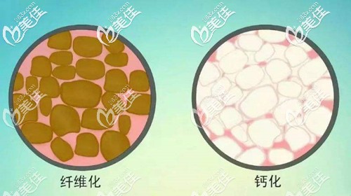 脂肪出現(xiàn)纖維化和鈣化的情況 脂肪出現(xiàn)纖維化和鈣化的情況