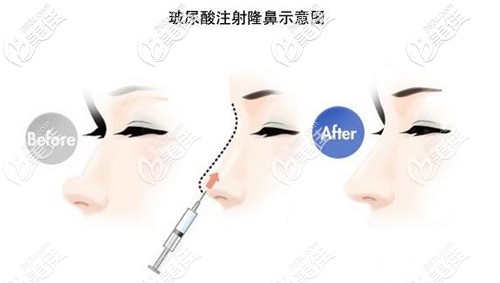 趙霞院長玻尿酸隆鼻特點(diǎn)圖解 趙霞院長玻尿酸隆鼻特點(diǎn)圖解