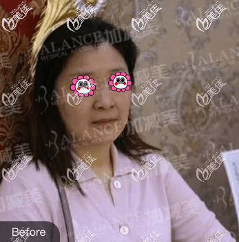 做V美減齡面部提升術(shù)前舊照 做V美減齡面部提升術(shù)前舊照