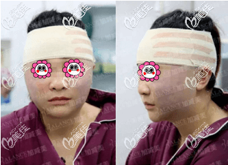 做V美減齡術(shù)后頭一日 做V美減齡術(shù)后頭一日